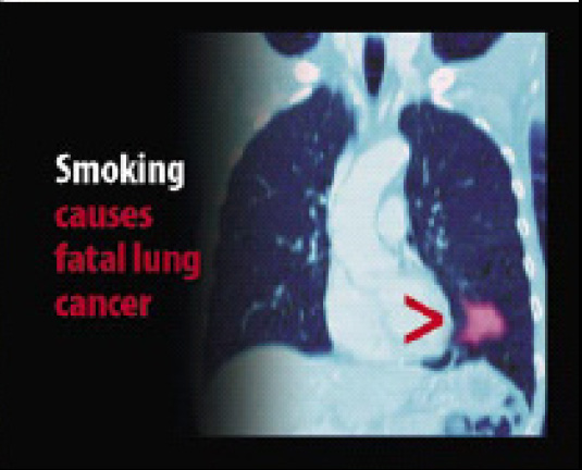 EU 2004 Health Effects lung - internal image, lung cancer
